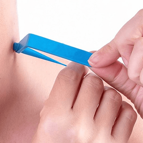 BYMCF® Skin Tag Remover